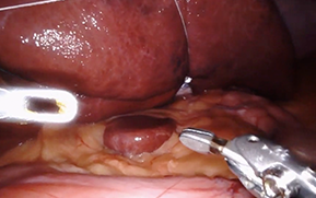 Adjustable Liver Retractor
