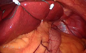 Adjustable Liver Retractor
