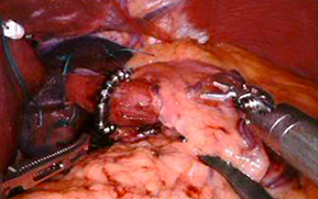 Cholecystectomy Retractor